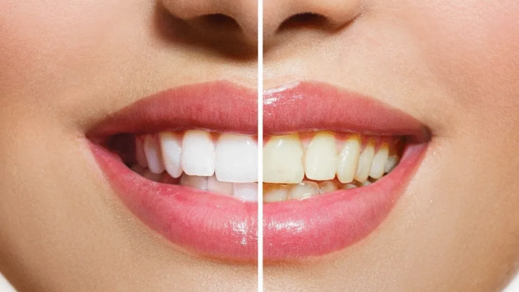 କେଉଁ-କାରଣରୁ-ଦାନ୍ତ-ହଳଦିଆ-ପଡିଥାଏ-?-ଏଥିରୁ-କେମିତି-ପାଇବେ-ମୁକ୍ତି,-ଜାଣନ୍ତୁ…