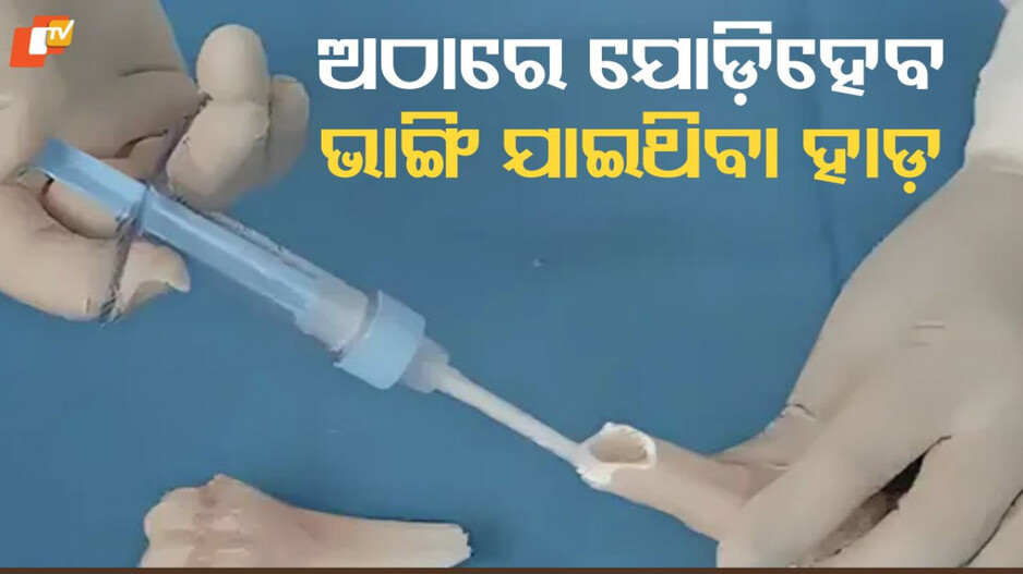 bone-glue:-ଚିକିତ୍ସା-ବିଜ୍ଞାନର-ଆଉ-ଏକ-ଚମତ୍କାର,-ଅଠାରେ-୩-ମିନିଟରେ-ଯୋଡିହେବ-ଭଙ୍ଗା-ହାଡ଼