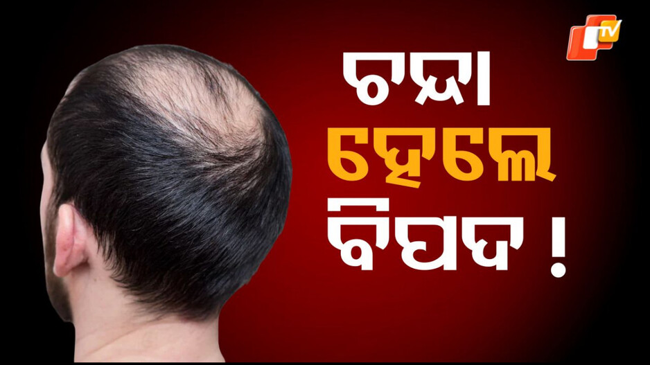 baldness-and-heart-health:-ଆପଣଙ୍କ-ଚୁଟି-ଝଡ଼ୁଛି-କି-ଧଳା-ହେଉଛି-କି-?-ଅଣଦେଖା-କରନ୍ତୁ-ନାହିଁ-…ହୋଇପାରେ-ଗମ୍ଭୀର-ସମସ୍ୟା